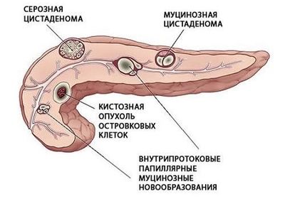 кистообразование и опухоли