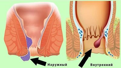 Как проявляется геморрой у мужчин: первые признаки и методы лечения