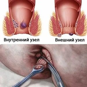 Как проявляется геморрой у мужчин: первые признаки и методы лечения