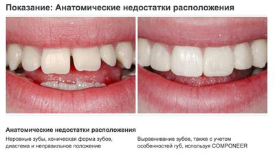 Реставрация зубов компонирами