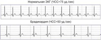 Низкий пульс