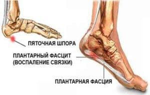 Криодеструкция