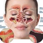 Риносинусит: симптомы и лечение у взрослых острой и хронической форм