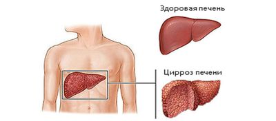 Разрушение печени
