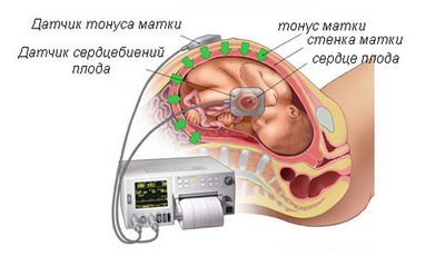 Определение ЧСС плода