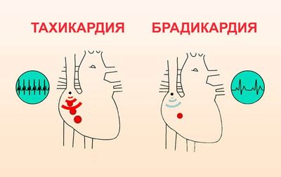 Тахикардия и брадикардия