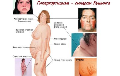 Синдром Иценко-Кушинга