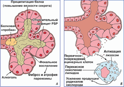 Алкогольный панкреатит