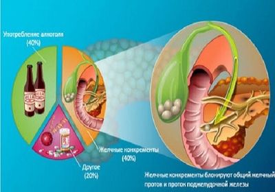 Причины панкреатита
