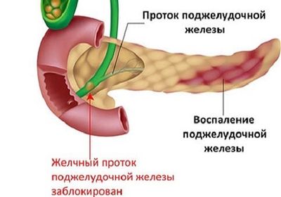 Воспаление ПЖ