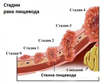 стадии рака желудка
