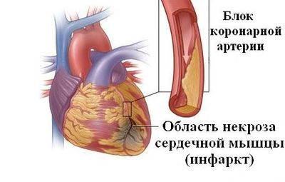 Инфаркт миокарда