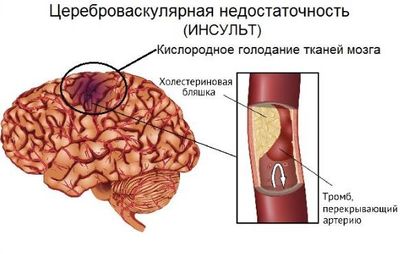 Цереброваскулярное заболевание