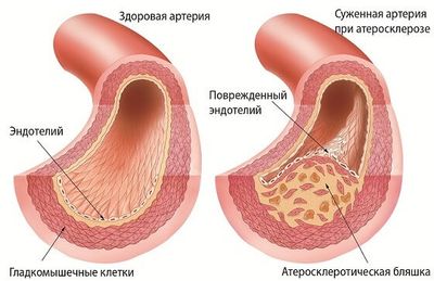 Атеросклероз