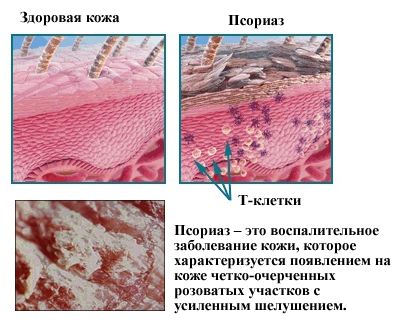 Псориаз