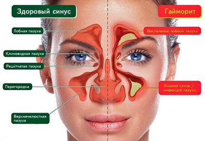 Гайморит и фронтит на схеме