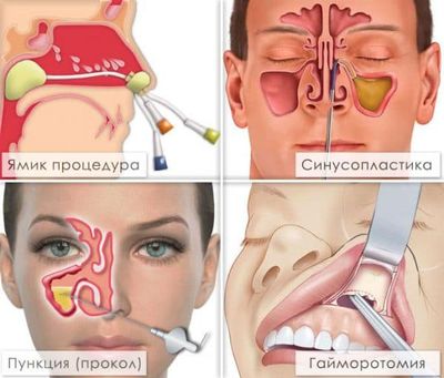 Виды операций и процедур, проводимых при гайморите