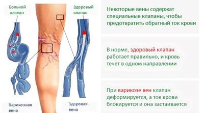 варикозное расширение вен