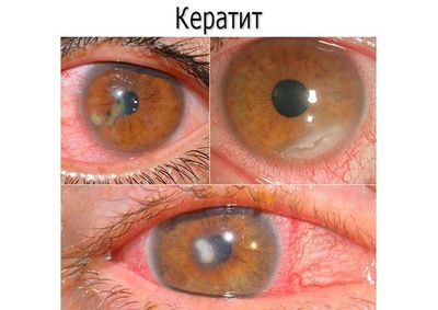 Тетрациклиновая мазь при болезнях глаз у детей