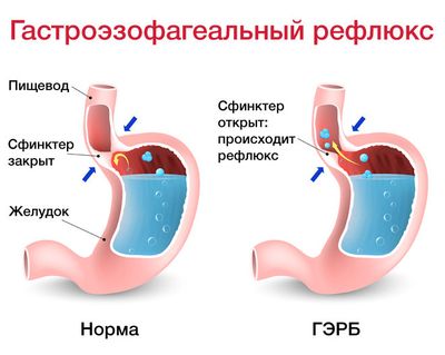 Гастроэзофагеальный рефлюкс