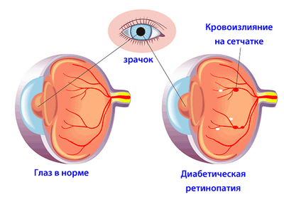 Ретинопатия