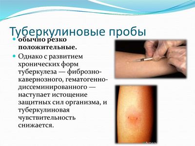 Туберкулиновые пробы