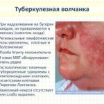 волчанка при туберкулезе