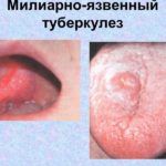 милиарно-язвенная форма