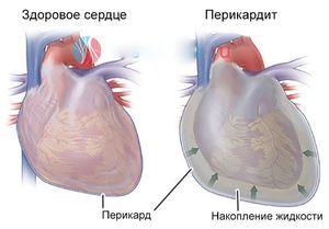 перикардит