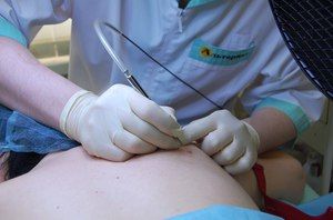 Какие родинки нельзя удалять