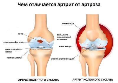 Чем отличается артрит от артроза