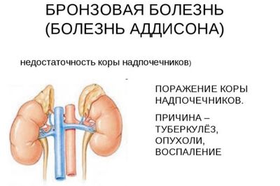 Болезнь Аддисона