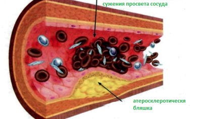 Атеросклероз