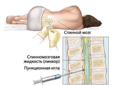 Пункция