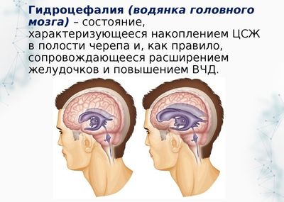Гидроцефалия