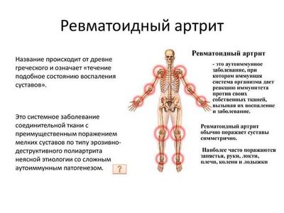 Ревматоидный артрит