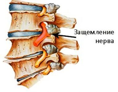 Симптомы и лечение защемления нерва в грудном отделе позвоночника
