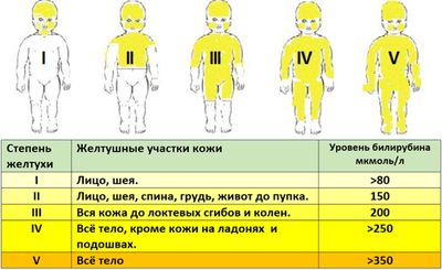 Степени желтухи у новорожденных