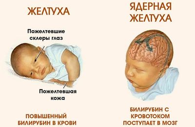 Желтуха новорождённых