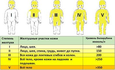 Степени желтухи