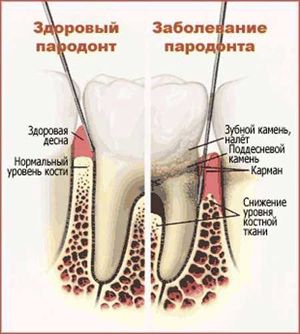 схема зубной камень