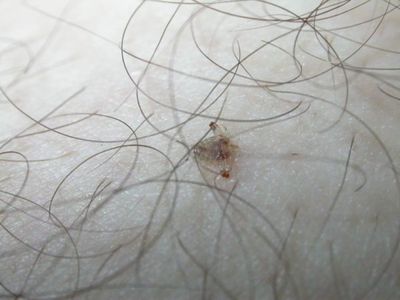 Зуд в паху у мужчин: симптомы, причины и лечение в домашних условиях 4